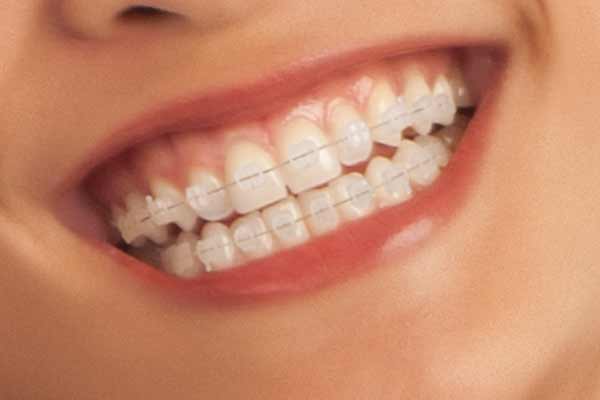 Clear Ceramic Aesthetic Adult Braces Hawthorn