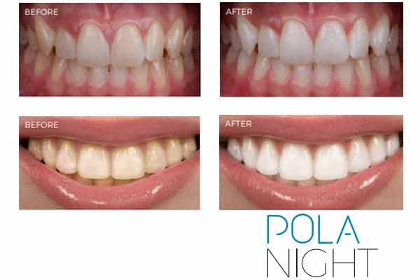 Pola Safe take home whitening