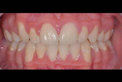 crowding treatment melbourne hawthorn