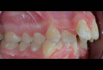 overjet treatment melbourne hawthorn