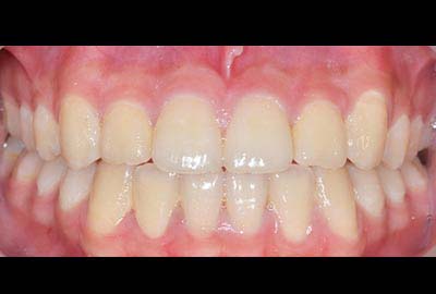 cross Bite treatment melbourne hawthorn